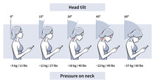 Load On Neck And Back When Posture Tilting Head With Phone, Pain Of Weight, Outline. Angle Of Bending Head Related To Pressure On Spine. Stage Text Neck Syndrome. Vector Illustration