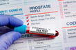 Blood tube test with requisition form for PSA Prostate Specific Antigen test. Blood sample tube for analysis of Prostate PSA profile test in laboratory