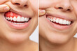 © Марина Демешко - Two shots of a young woman with red bleeding gums and health gums, before and after treatment on a white background. Result of curing of gum inflammation. Close up. Dentistry, dental care