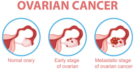 Canvas Print - ovarian cancer development process infographic