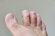close-up of a man's toes with fungal disease, skin cracking and callus formation on his toes,