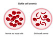 Sickle cell disease. The difference of Normal red blood cell and sickle cell.