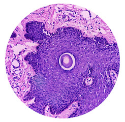 Wall Mural - Skin(biopsy): Seborrhoeic keratosis, epidermis show hyperkeratosis, acanthosis, pseudo horn cysts, focal area of squamous eddies.