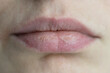 Closeup caucasian woman face with brittle and dry chapped lips, soft focus. Peeling, coarsening, discomfort and cold season. Beauty dermatology, skin sensitivity concept. 