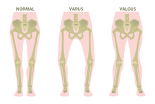 Valgus And Varus Leg Deformities. Diagram Showing The Deformed Bones Of The Lower Extremities. Cosmetic Pathology. Vector Illustration.
