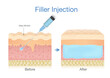 Filler injection into the skin layer by a needle for beauty surgery. Illustration about the result of skin treatment to reduce wrinkle.