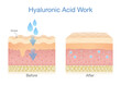 Skin layer getting Hyaluronic Acid increases skin moisture and reduces the appearance of fine lines and wrinkles.