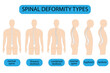 Spine deformity vector illustration. Kyphosis, lordosis spine infographic. Diagram with spine curvature and healthy spine. Posture defect. Medical, educational and scientific banner