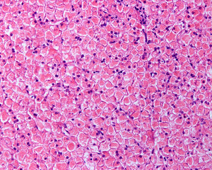 Sticker - Human liver. Glycogenosis