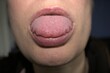 swollen enlarged white tongue with wavy ripple scalloped edges (medical name is macroglossia) and lie bumps
