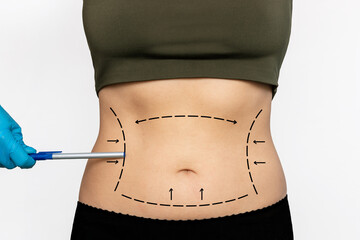 Woman's lined belly with excess fat and doctor's gloved hand pointing on marking stomach with a pen isolated on a white background. Overweight, excessive weight. Liposuction, plastic surgery concept