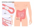 ileus bowel toxic small midgut cecal colon tract Hirschsprung's gastric Ladd band large hiatal hernia cancer tumor swollen crohn's x-ray meckel's twist blocked birth defect infant children pain short