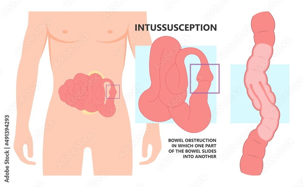 Colon Defect ileus bowel toxic small midgut cecal colon tract Hirschsprung's gastric ...