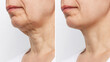 Lower part of the face and neck of elderly woman with signs of skin aging before and after facelift, plastic surgery on white background. Age-related changes, flabby sagging skin, wrinkles, creases