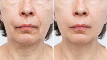 Lower Part Of Face And Neck Of Elderly Woman With Signs Of Skin Aging Before After Facelift, Plastic Surgery On White Background. Age-related Changes, Flabby Sagging Skin, Wrinkles, Creases, Puffiness