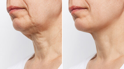 lower part of the face and neck of elderly woman with signs of skin aging before and after facelift,