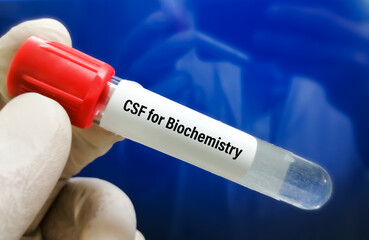 Sticker - Biochemist hold Cerebrospinal fluid (CSF) sample for biochemistry test including glucose, protein, ADA