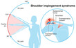 Shoulder impingement syndrome. Painful arc. Labeled Illustration