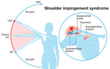 Shoulder Impingement Sydrome. Painful Arc. Labeled Illustration