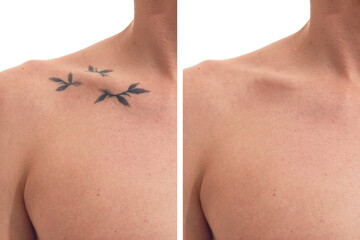 Before and after laser tattoo removal on a man.