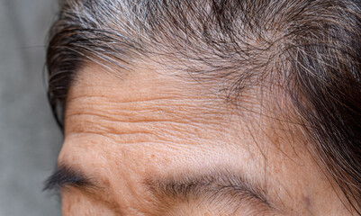 Skin creases or wrinkles at oily forehead of Southeast Asian, Myanmar or Burmese elder woman. Symptom of aging.