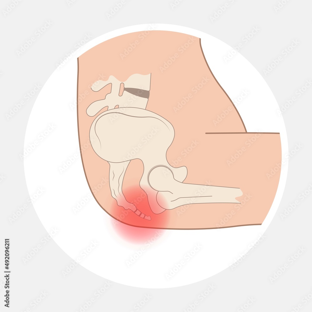 Tail bone pain floor hip spine sitting down back leg fall slip broken ...