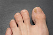 Toenails with fungus problems,Onychomycosis, also known as tinea unguium, is a fungal infection of the nail, gray table.