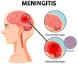 Diagram showing meningitis in human brain