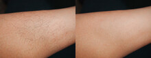 Image Before And After Leg Hairs Removal Concept.

