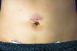 Woman's abdomen fresh medical scars after laparoscopy surgery, remove gallbladder, ovary, uterus, tumor. Wounds on woman's body, abdomen with band-aid. Belly button fresh stitches, hematoma, bruising.