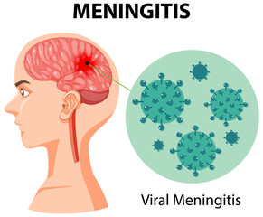 Canvas Print - Diagram showing meningitis in human brain