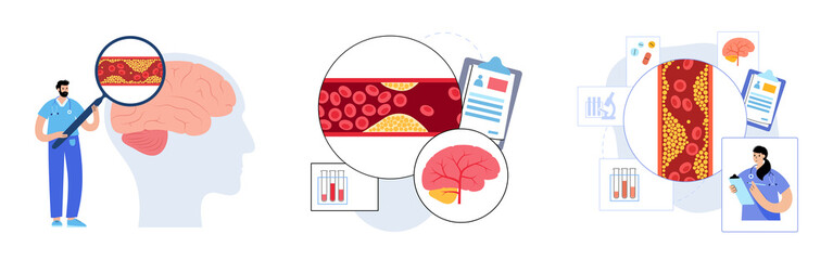 Brain stroke ishemic