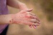 Close up dermatitis on skin, ill allergic rash eczema skin of patient , atopic dermatitis symptom skin detail texture , Fungus of skin ,The concept dermatology, treatment fungal