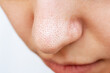 © Марина Демешко - Close-up of a woman's nose with black heads or black dots isolated on a white background. Acne problem, comedones. Enlarged pores on a face. Cosmetology dermatology concept. Blackheads on greasy skin
