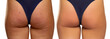 © vladimirfloyd - Female buttocks before and after treatment