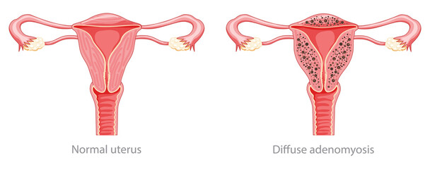 Wall Mural - Diffuse Adenomyosis Human anatomy Female Sick and normal reproductive system organs. Location scheme Cross section uterus, cervix, ovary, fallopian tube icon. Vector illustration isolated on white