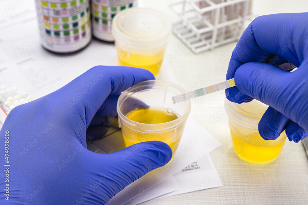 urine test, made with a vial of Urinalysis Reagent Strip used for ...