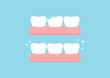 Injury chipped tooth and healthy tooth before, after treatment icon set. Broken teeth with problem treatment concept. Flat cartoon style vector illustration.