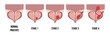 Medical diagram of 4 stages of prostate cancer. tumor grows and penetrates into neighboring organs and tissues.