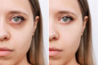 Cropped shot of young caucasian woman's face with dark circles under eyes before and after cosmetic treatment. Bruises under eyes caused by fatigue, insomnia. Result of therapy, use of concealer