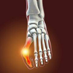 Poster - Toe deformation, also known as hallux valgus, or bunion