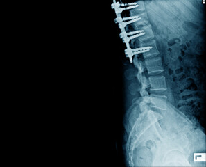 Wall Mural - Lateral view of structure bone with internal fixation for prevent compression spine bone