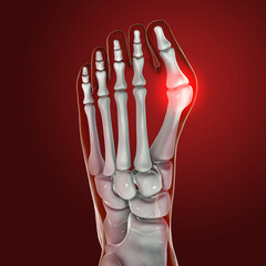 Poster - Toe deformation, also known as hallux valgus, or bunion