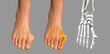 © Dr_Microbe - Toe deformation, also known as hallux valgus, or bunion