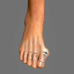 Canvas Print - Toe deformation, also known as hallux valgus, or bunion