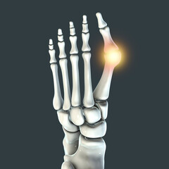 Canvas Print - Toe deformation, also known as hallux valgus, or bunion