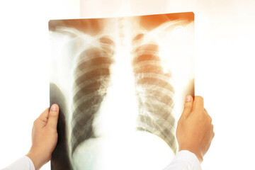 X-ray of the lungs is where X-rays are directed into a part of the chest or lungs where the radiograph images are recorded on film