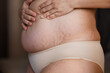 © Юля Бурмистрова - Cropped image fat overweight woman hand on tummy, with stretch marks, striae. Corpulence fat folds hanging, diastasis. Body after childbirth, fibrous collagen, dehydrated. Skin puffiness. Close up