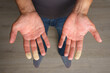 © Creative Cat Studio - Man showing hands with Raynaud syndrome, Raynaud's phenomenon or Raynaud's disease