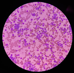 Canvas Print - Chronic myeloid leukemia(CML) is a type of blood cancer. show the increased and unregulated growth of myeloid cells, mononuclear cells in blood smear.